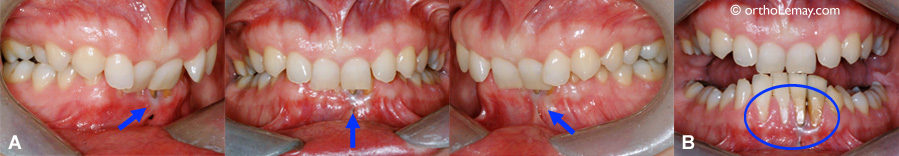 Dental and gingival wear with a significant malocclusion
