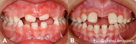 Opening of a dental space during the rapid maxillary expansion.