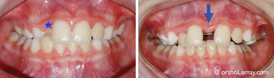Enlargement of the palate using palatal maxillary expansion