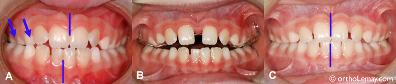 Rapid palatal expansion to correct a crossbite orthodontically