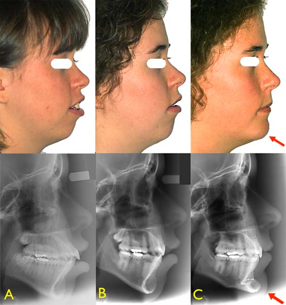 In addition to having orthodontics correct the position of the teeth, a chin advancement surgery (genioplasty) allowed the change in this 18-year-old teenager's profile. Pictures: (A) Before the orthodontic treatment, (B) after the orthodontic treatment and (C) after genioplasty. – (Courtesy: Dr Sylvain Chamberland, Québec)