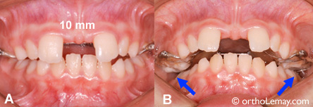Dental expansion overcorrection in orthodontics