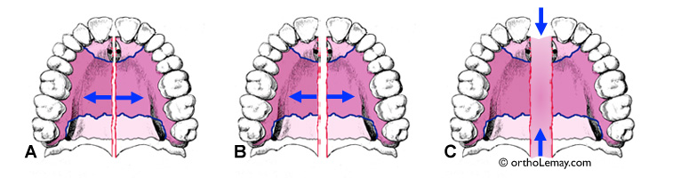 Opening of the maxillary suture during rapid expansion