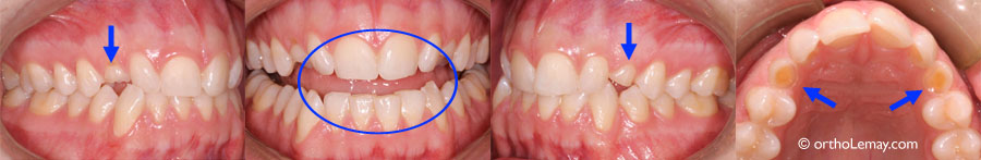 Tooth wear and impacted canines orthodontics