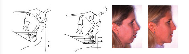 Genioplastie chirurgie oral health orthodontie sherbrooke 1
