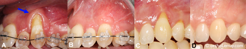 Gingival graft to cover a gingival recession on a canine.