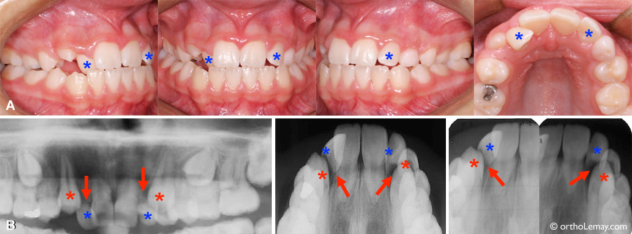 Severe resorption of lateral incisors by impacted canines at 12 years of age