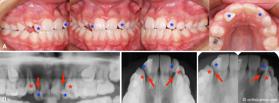 canine teeth wrong place