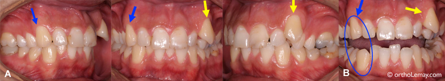 Canine function and tooth wear