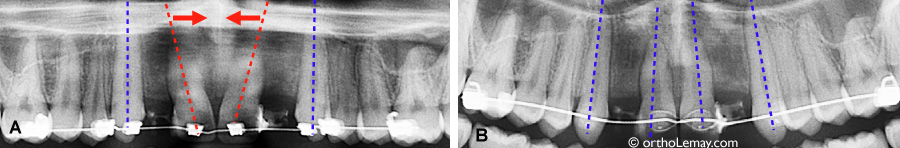 Orthodontically uprighting of the dental roots to get a site ready for dental implants.
