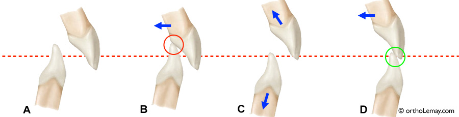 Bite opening ouverture occlusion orthodontie Sherbrooke 1 Ouverture de l'occlusion (bite opening) par intrusion des incisives en orthodontie