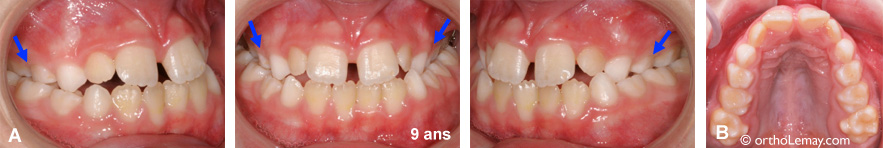 Snoring and sleep apnea in a child presenting a malocclusion with a crossbite