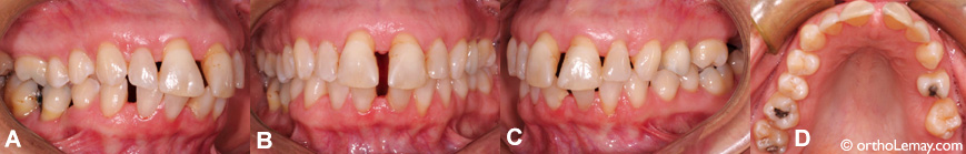 Dental spaces, periodontics, tongue pressure and malocclusion