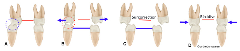 Overcorrection and dental interferences during the rapid maxillary expansion in orthodontics