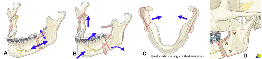 Advancement mandibular surgery with bilateral sagittal split osteotomy.