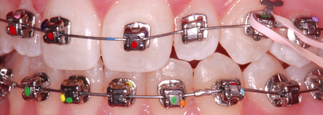 points de couleur boitiers Damon brackets Points de couleur sur les boîtieindiquer la dent et l'inclinaison de la fente du boîtier. rs ou brackets Damon