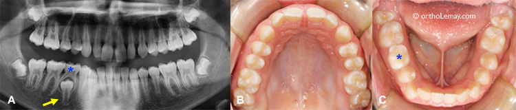 Dental lateness and normal eruption radiograph