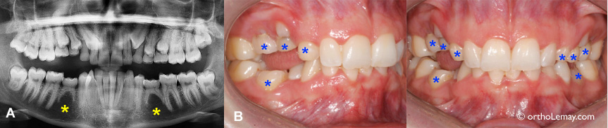 treatment delayed eruption teeth