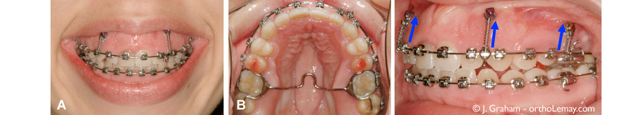  Mécanique orthodontique utilisée pour faire l'ingression du maxillaire supérieur