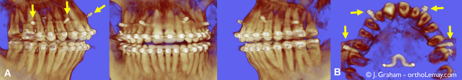 Tomodensitométrie volumique à faisceau conique (TVFC) montrant la position de mini-vis d’ancrage utilisées pour l'ingression orthodontique d'un sourire gingival. Cas traité par John Graham, Phoenix, AZl.