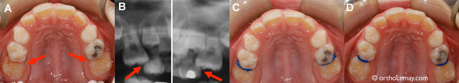  (A) Les deux molaires supérieures permanentes sont bloquées derrière les molaires temporaires. (B) Une radiographie permet de confirmer ce diagnostic en montrant les molaires prises sous les autres dents (flèches). (C) Pour débloquer les molaires, des "séparateurs" élastiques sont insérés entre les dents. (D) 10 semaines plus tard, les molaires sont débloquées et les séparateurs peuvent être enlevés. Voila!