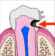Dental carie developing under an orthodontic bracket
