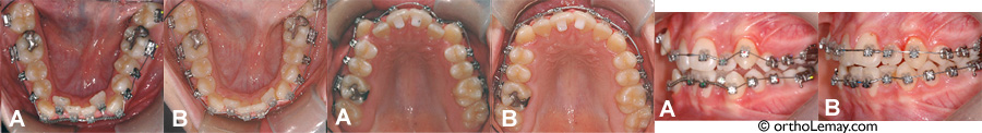 Corrections orthodontiques après 10 semaines.