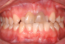 Des dents dévitalisées ou "mortes" deviennent plus sombres. Ceci n'est habituellement pas une contre-indication à l'orthodontie