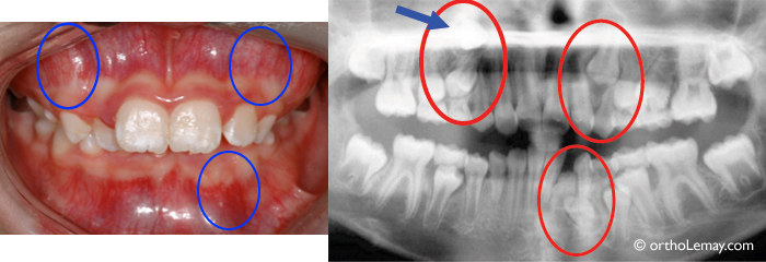 Problèmes d'éruption visibles sur une radiographie. 