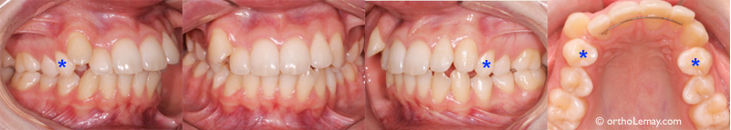 cas dxtnr de prémolaires traité en orthodontie par Invisalign 