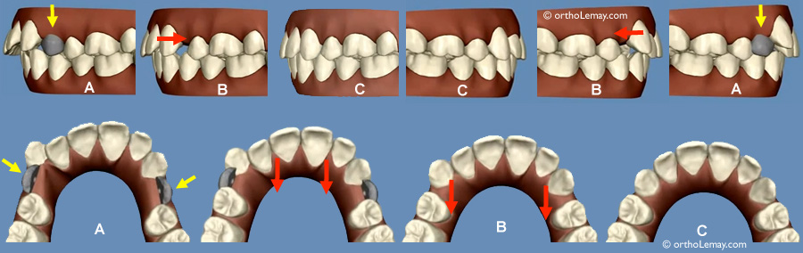 Extraction de prémolaires et traitement Invisalign 