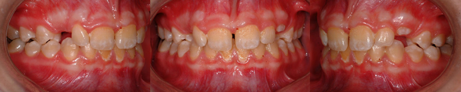 La présence de taches et l'accumulation de plaque sur cette dentition est un signe de mauvaise hygiène buccale et peut être une contre-indication à entreprendre un traitement d'orthodontie. Afin d'éviter des porblèmes de caries et de décalcification, l'hygiène doit être impeccable pendant le port d'appareils orthodontiques.