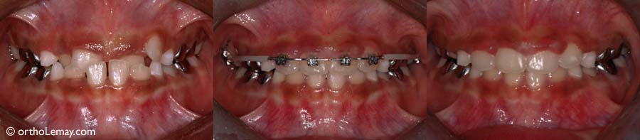 Occlusion croisée antérieure SB 073133 Lemay orthodontiste Sherbrooke ections faites à l'aide d'appareils fixes (broches). Correction de deux centrales supérieures mordant vers l'intérieur chez une fille de 7 ans. Corrections faites à l'aide d'appareils fixes (broches).