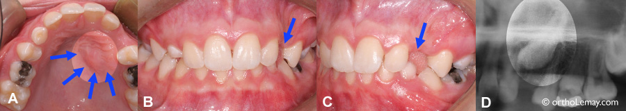 Example of the importance of taking dental radiographs