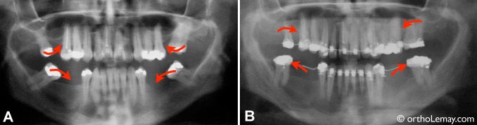 (A) A 50-year-old woman who lost several posterior teeth, which caused the tipping of the other molars throughout the years (arrows). Orthodontics made it possible to upright the molars in a better position, which will help the dentist replace the missing teeth after the orthodontic treatment. (B)