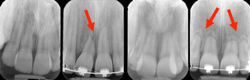 Résorption modérée ayant affecté une centrale dans un cas et plusieurs dents dans l'autre cas. 