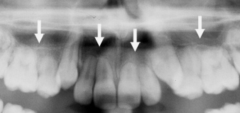 La résorption de racines peut être présente avant même le début d'un traitement d'orthodontie comme le démontre cette radiographit d'une fille de 12 ans.