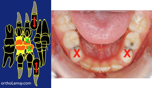 En présence d'un manque d'espace sévère pour l'éruption des dents permanentes, des dents temporaires peuvent être extraites (X) pour aider l'éruption des dents permanentes (flèches).