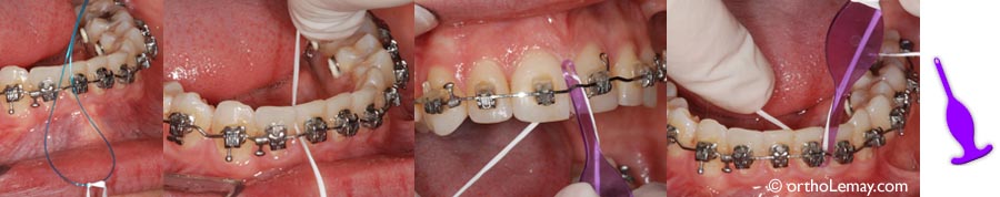 Des aides tels que des enfileurs permettent d'utiliser la soie dentaire pendant un traitement d'orthodontie avec des appareils fixes broches).