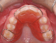 Mainteneur d'espace supérieur (amovible) empêchant le déplacement des dents