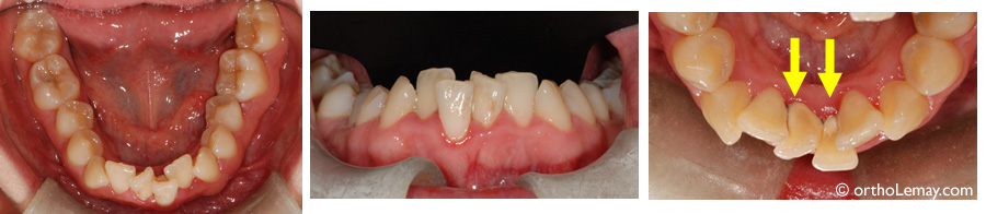 Les dents chevauchées sont plus difficiles à nettoyer et favorisent l'accumulation de plaque dentaire et la formation de tartre.