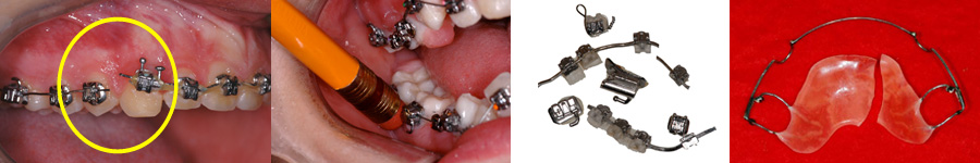 Urgence orthodontique orthodontic emergency lemay