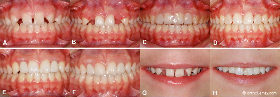 anodontie laterales orthodontie 073239 ST16 summary1