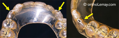 Usure sur un appareil de rétention orthodontique amovible en plastique. Les canines percent souvent de telles coquilles. La décoloration est aussi fréquente. 