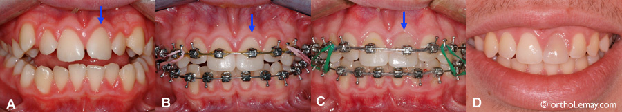 L'orthodontie ne cause pas de dévitalisation des dents