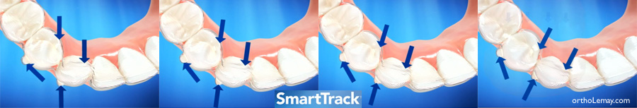 SmartTrack le nouveau plastique pour Invisalign est plus confortable et performant.