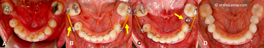Utilisation d'appareils orthodontiques fixes pour maintenir un espace en attendant un remplacement prothétique.