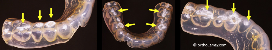 Usure d'un appareil de rétention orthodontique essix