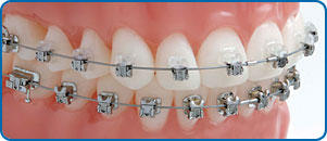 Damon clear braces broches boîtiers Damon orthodontistes Lemay