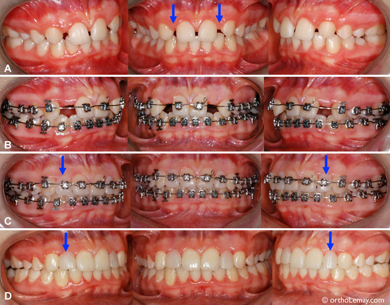 (A) Les deux incisives latérales supérieures sont absentes (anodontie) (flèches). (B) Ouverture des espaces des incisives latérales en orthodontie pour les remplacer éventuellement par des implants. (C) Pendant le traitement, avec dents artificielles ajoutées sur les "broches" pour améliorer l'esthétique. (D) À la fin du traitement, des dents sont ajoutées pour maintenir la largeur de l'espace en attendant la pose des implants et couronnes finales. L'esthétique de ces couronnes sera meilleure que les dents temporaires en place.